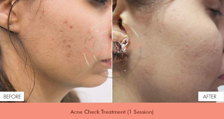 acne-check-treatment-before-after