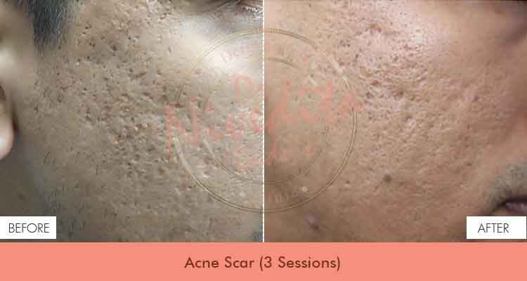 acne-scar-before-after