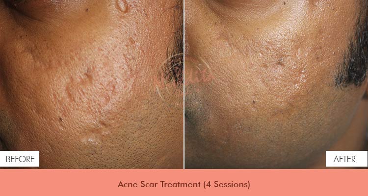 acne-scar-before-after