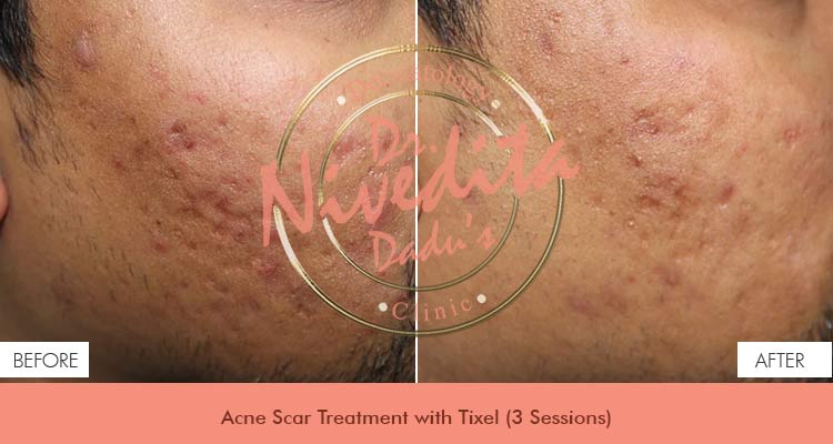 Acne scar laser Before After