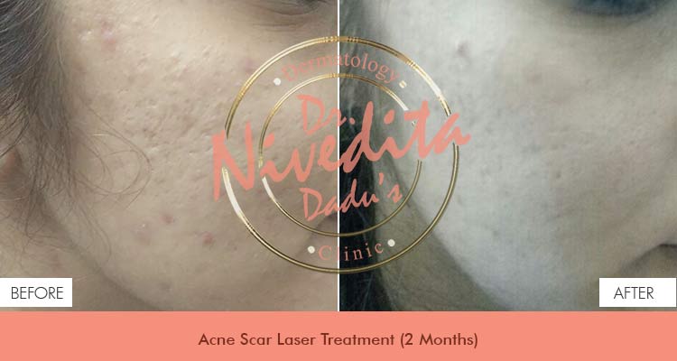 Acne scar laser Before After