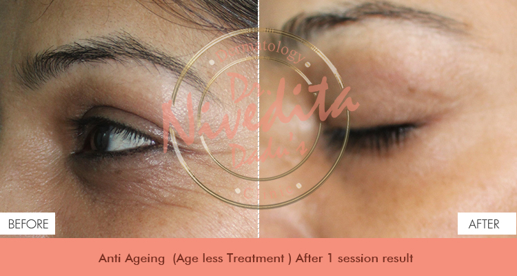 before-after-anti-aging
