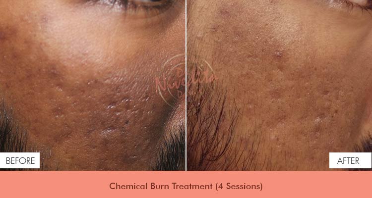 chemical-burn-before-after