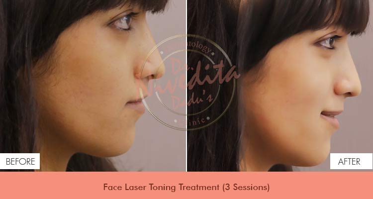 face-laser-toning-before-after