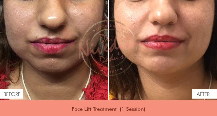 face-lift-before-after