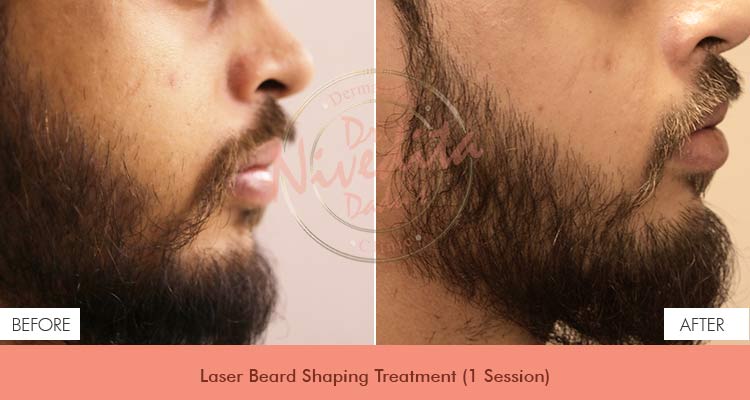 laser-beard-shaping-before-after