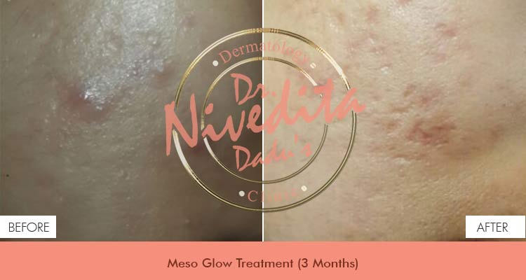 meso-glow-treatment Before After