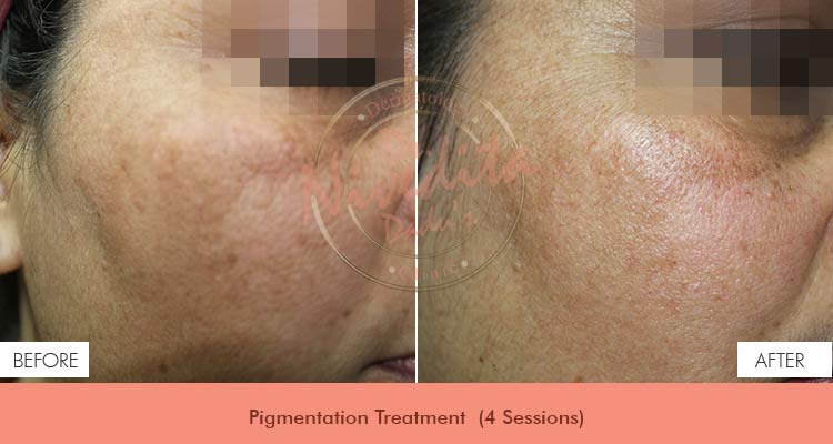 pigmentation-before-after