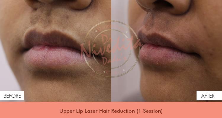 upper-lip-laser-hair-reduction-before-after
