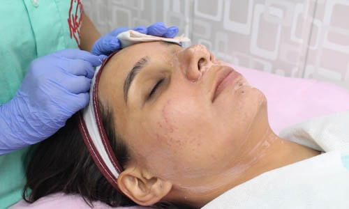 Acne Check Peel Treatment