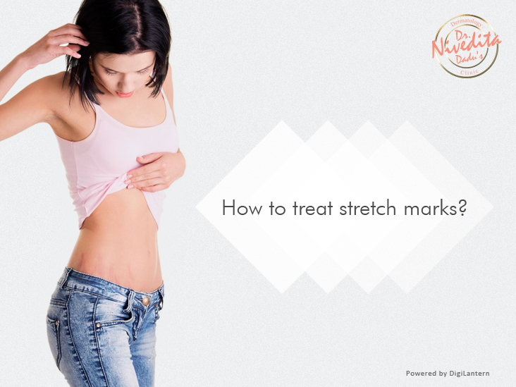 Stretch Marks Treatment
