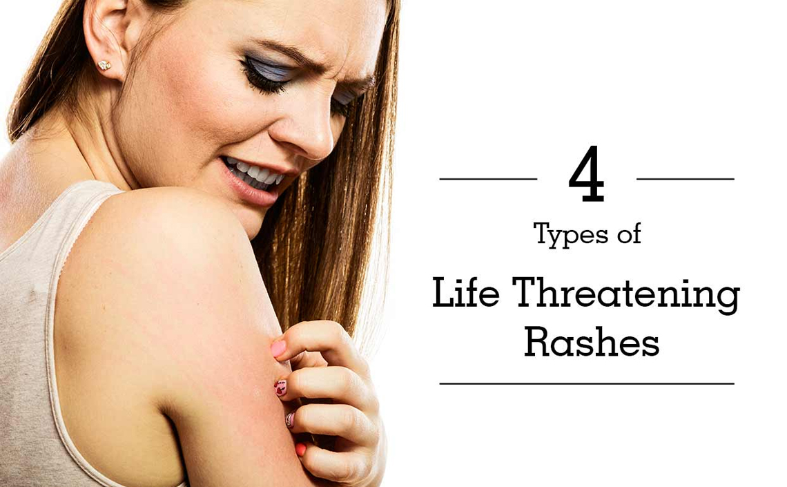 4 Types of Life Threatening Rashes on Our Skin