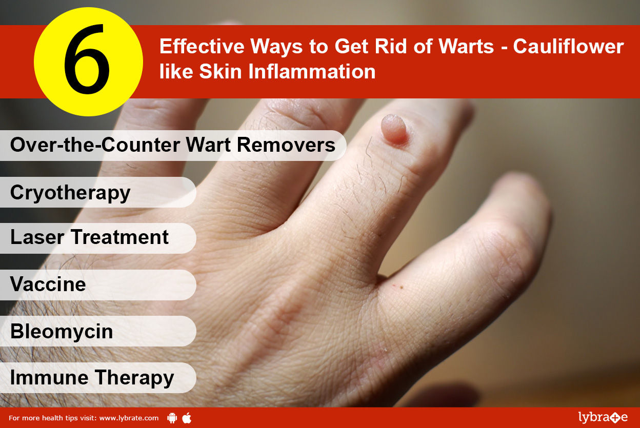 6 Effective Ways to Get Rid of Warts