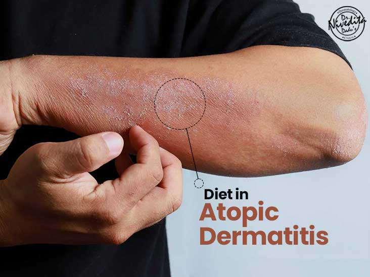 diet in atopic dermatitis