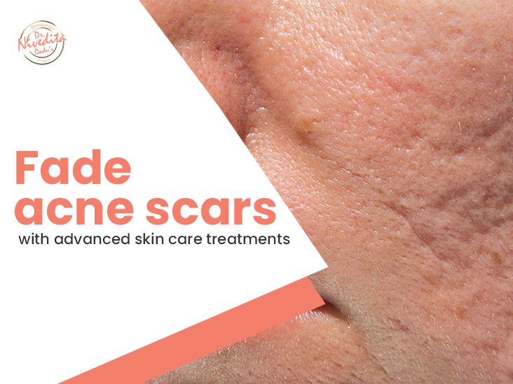 Acne Scar Treatment in Delhi