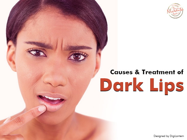 Causes, Treatments & Prevention of Dark Lips | How to Lighten Dark Lips