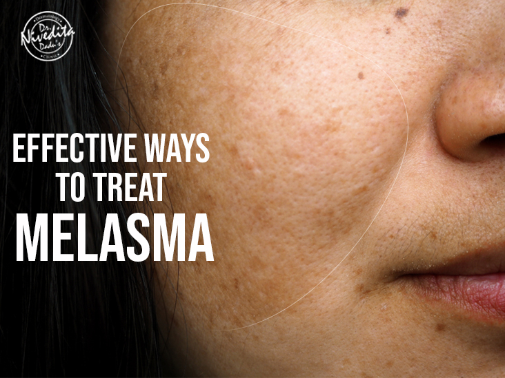 Effective Ways To Treat Melasma