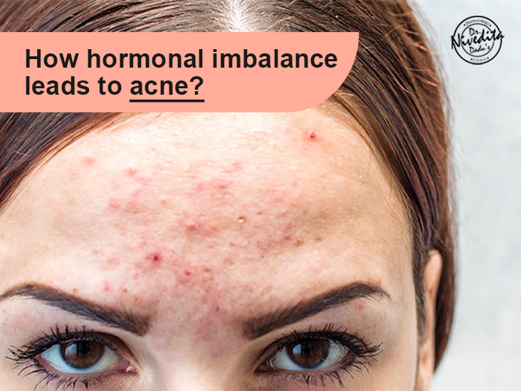 How Hormonal Imbalance Leads To Acne?