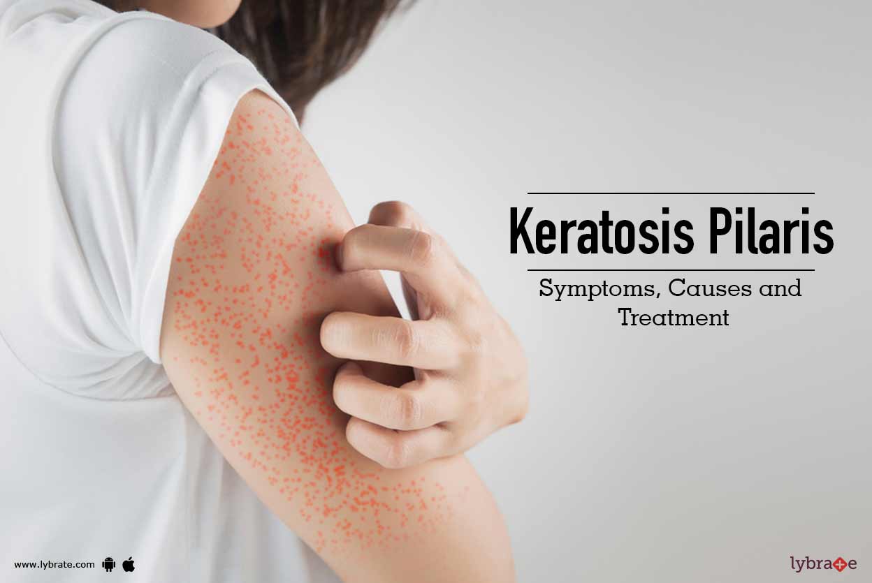Keratosis Pilaris Symptoms Causes And Treatment