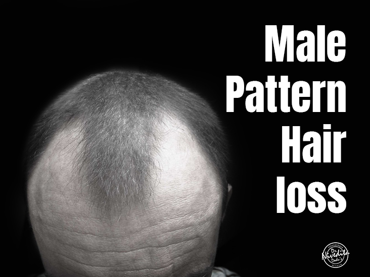 Male Pattern Hair loss