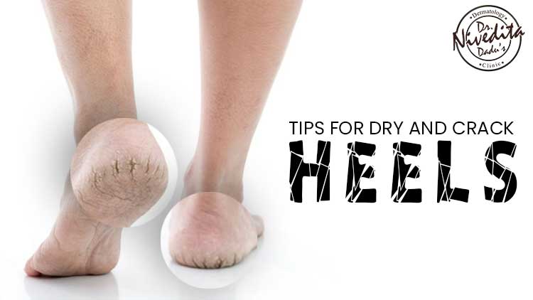 How to Treat Dry Cracked Heels with Seattle Foot Doctor Larry Huppin -  YouTube