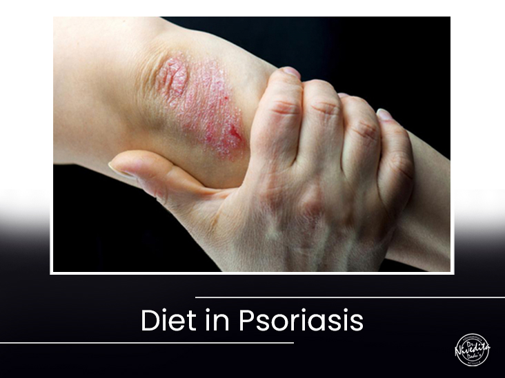 Diet in Psoriasis