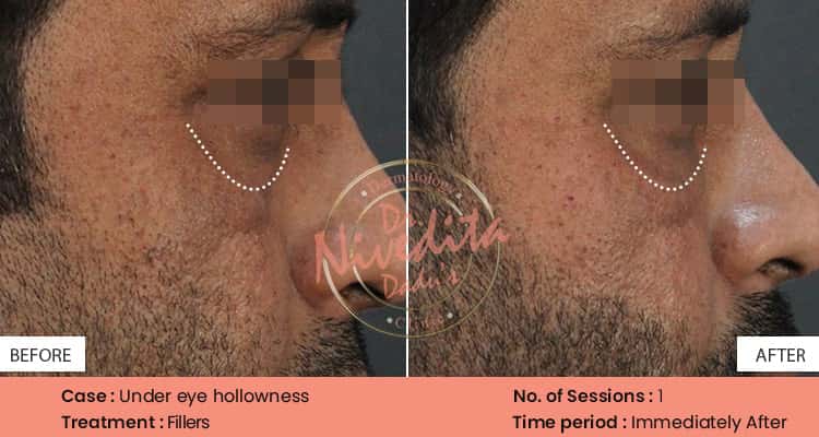 anti-ageing Before After