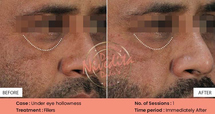 anti-ageing Before After