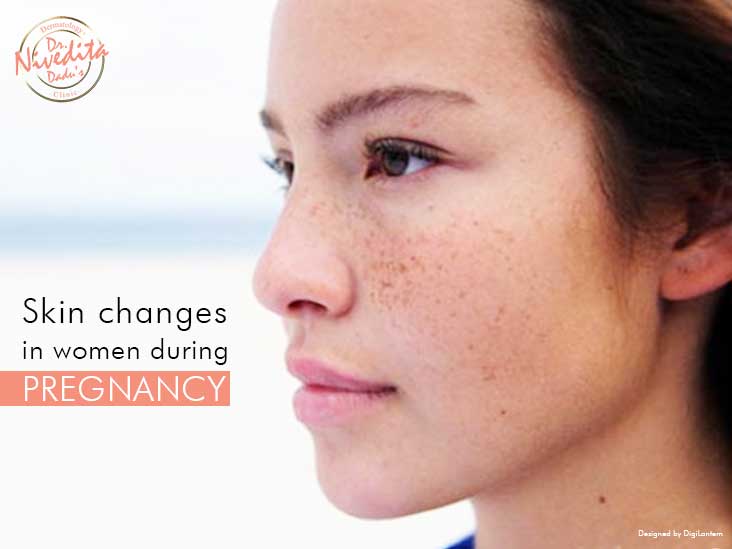 Skin changes in women during Pregnancy