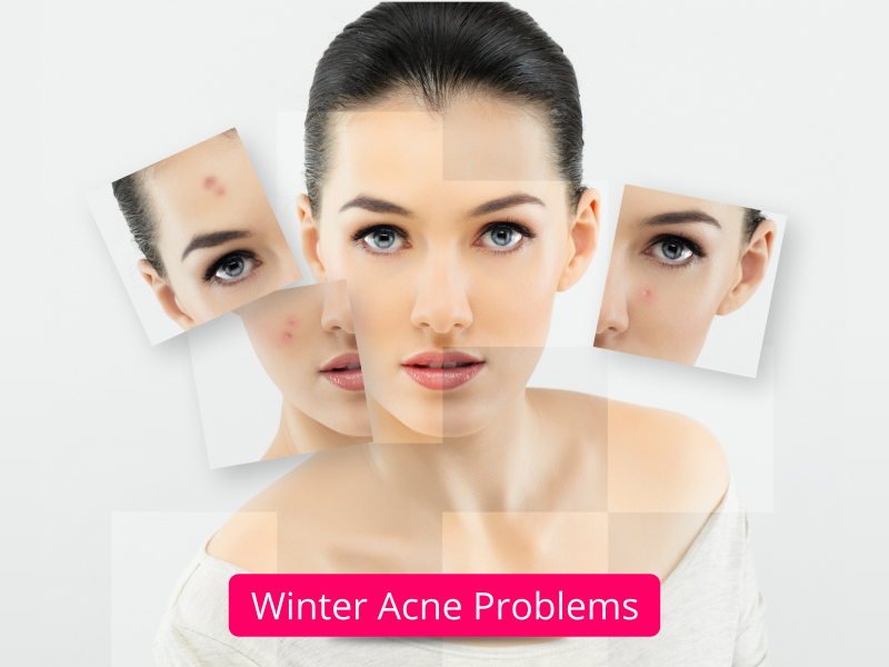 Winter Acne Face Clean