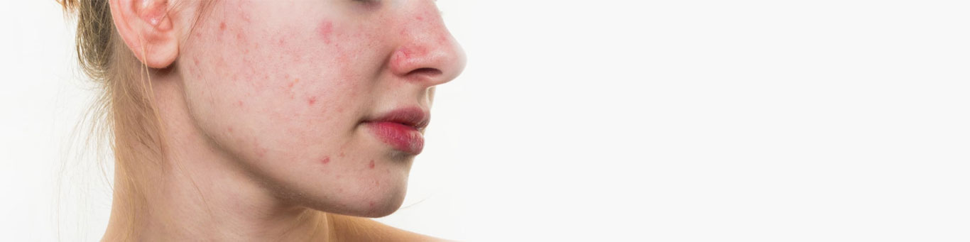 Acne Scars Treatment in Delhi
