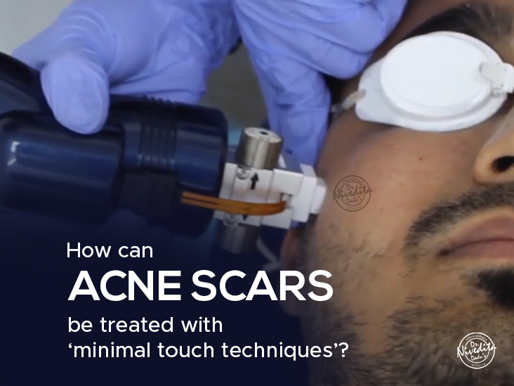 Acne Scars Treatment