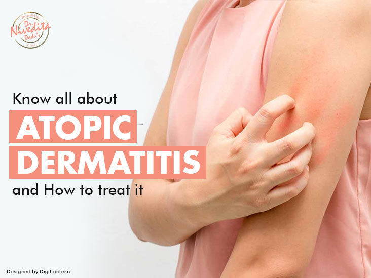 atopic dermatitis