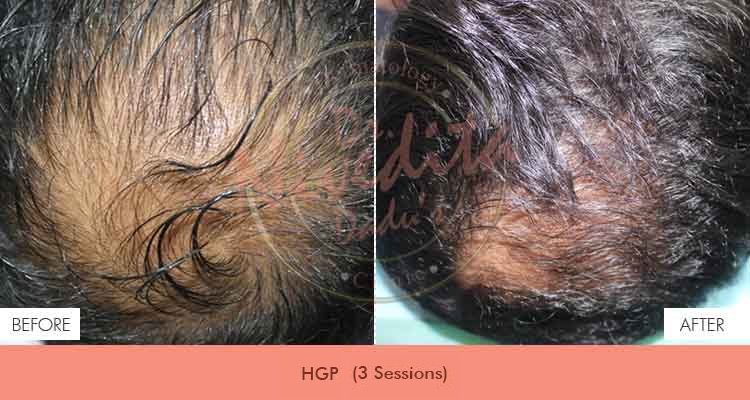 Hair Restoration Results 