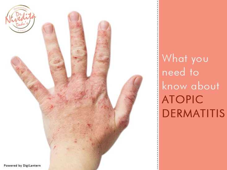Atopic Dermatitis Skin Disorder
