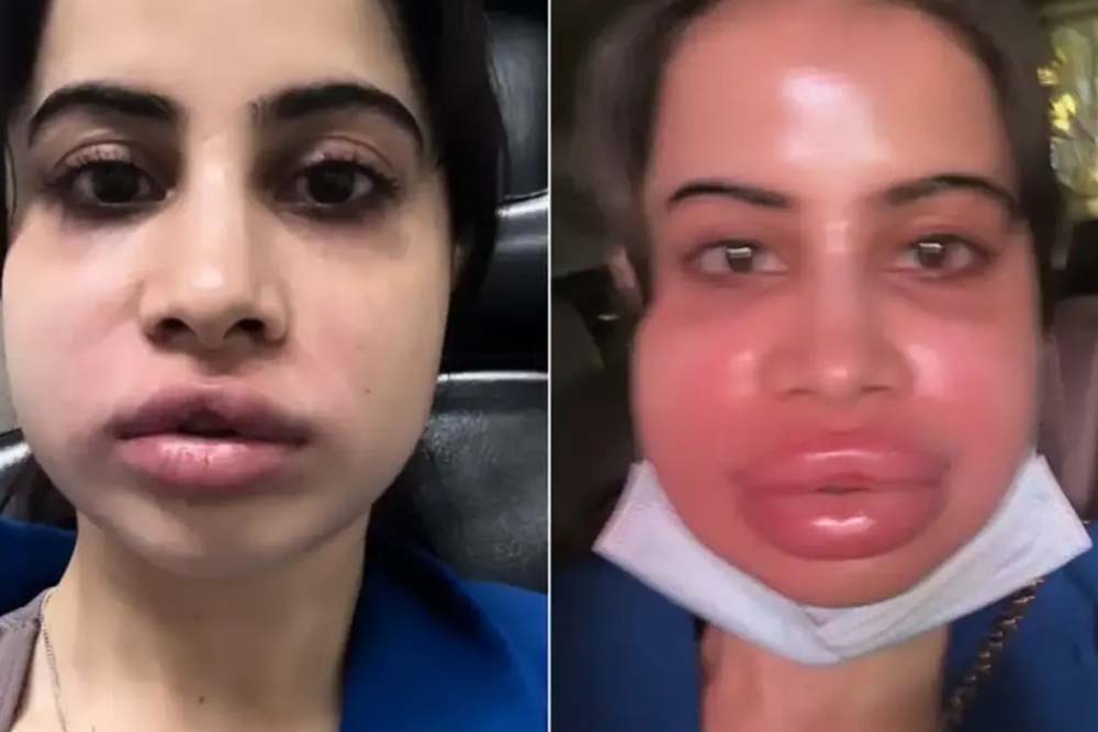 lip filler correction treatment in Delhi