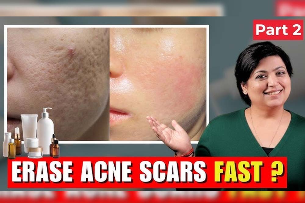 Acne Scar Treatment