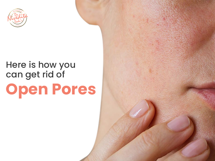 Open Pores Treatment