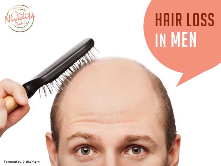 Hair Loss in men
