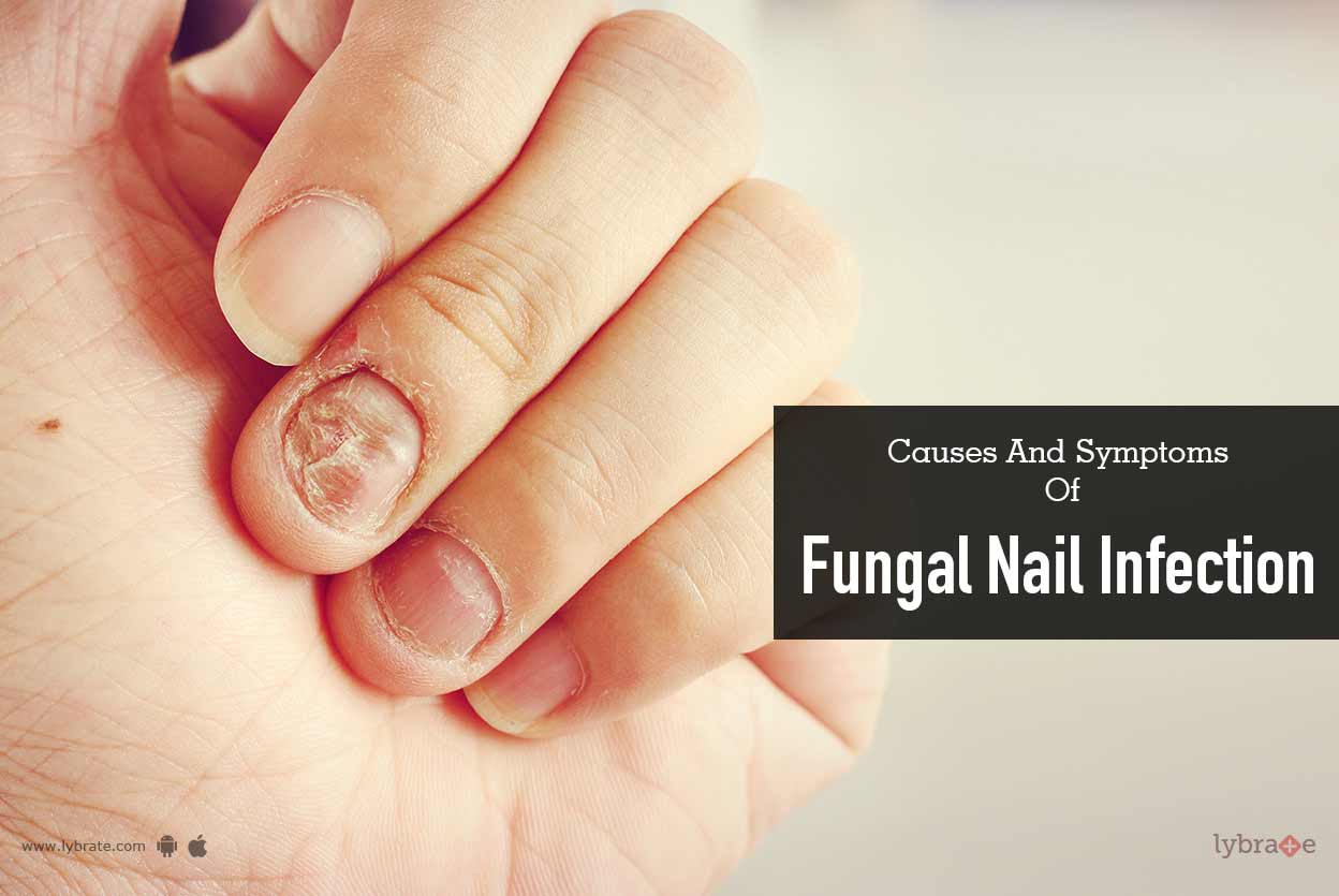 Can Acrylic nails cause Nail Fungi? | Elim Spa Products