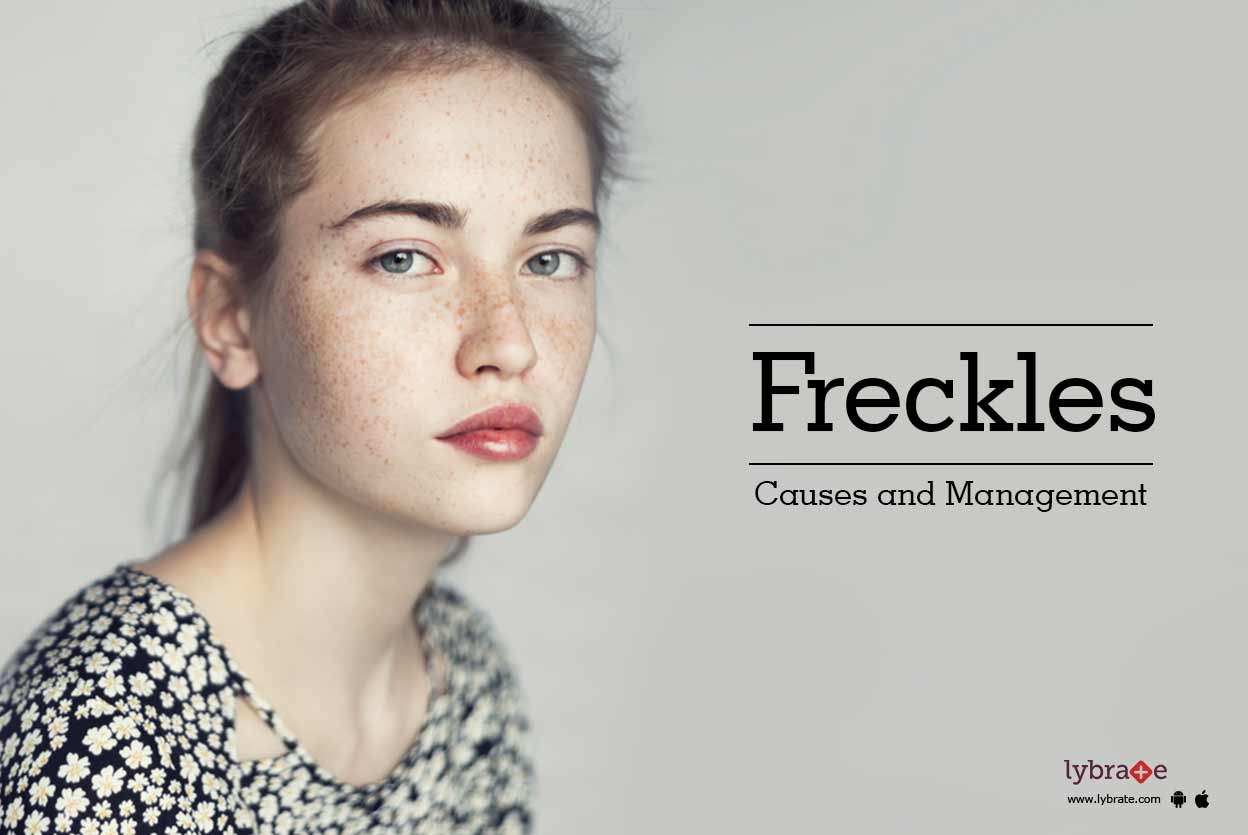Freckles Causes and Management