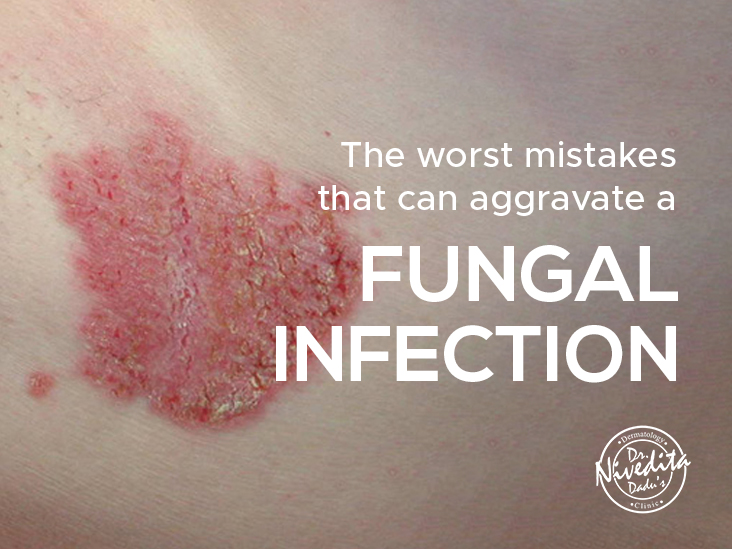 The Worst Mistakes that can Aggravate a Fungal Infection