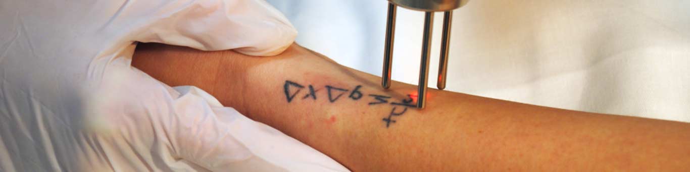 Permanent Laser Tattoo Removal