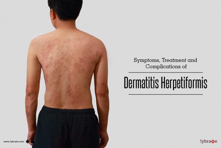 Symptoms, Treatment of Dermatitis Herpetiformis